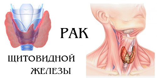 Операции опухолей щитовидной железы