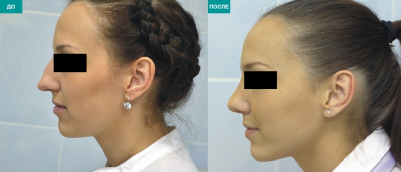 Контурная пластика носа